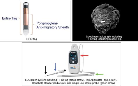 rfid tag breast|rfid breast cancer.